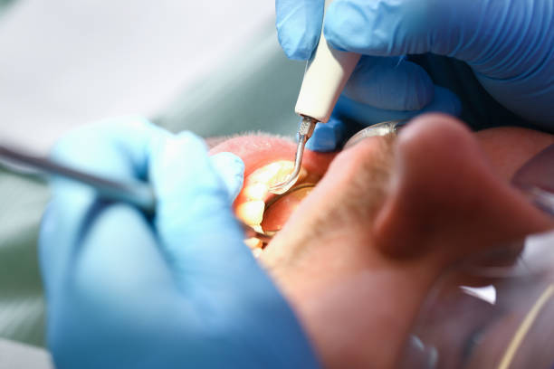 Best Emergency Treatment for Dental Infections or Abscesses in Fayetteville, NY