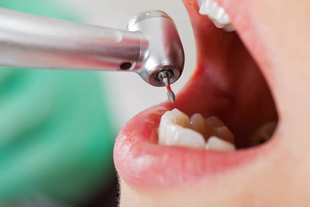 Best Emergency Dental Care for Broken or Chipped Teeth in Fayetteville, NY
